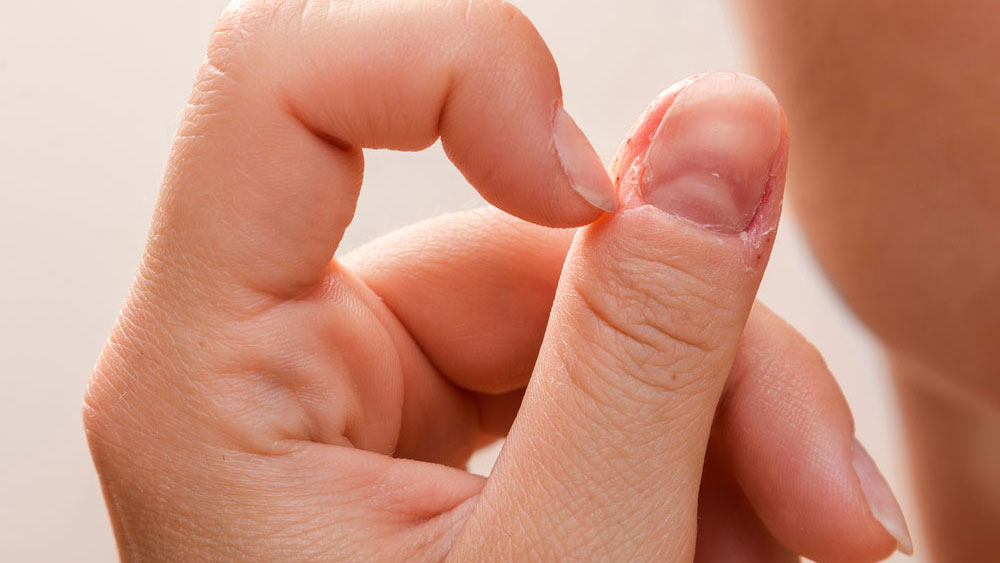 Skin Picking Habit stopped